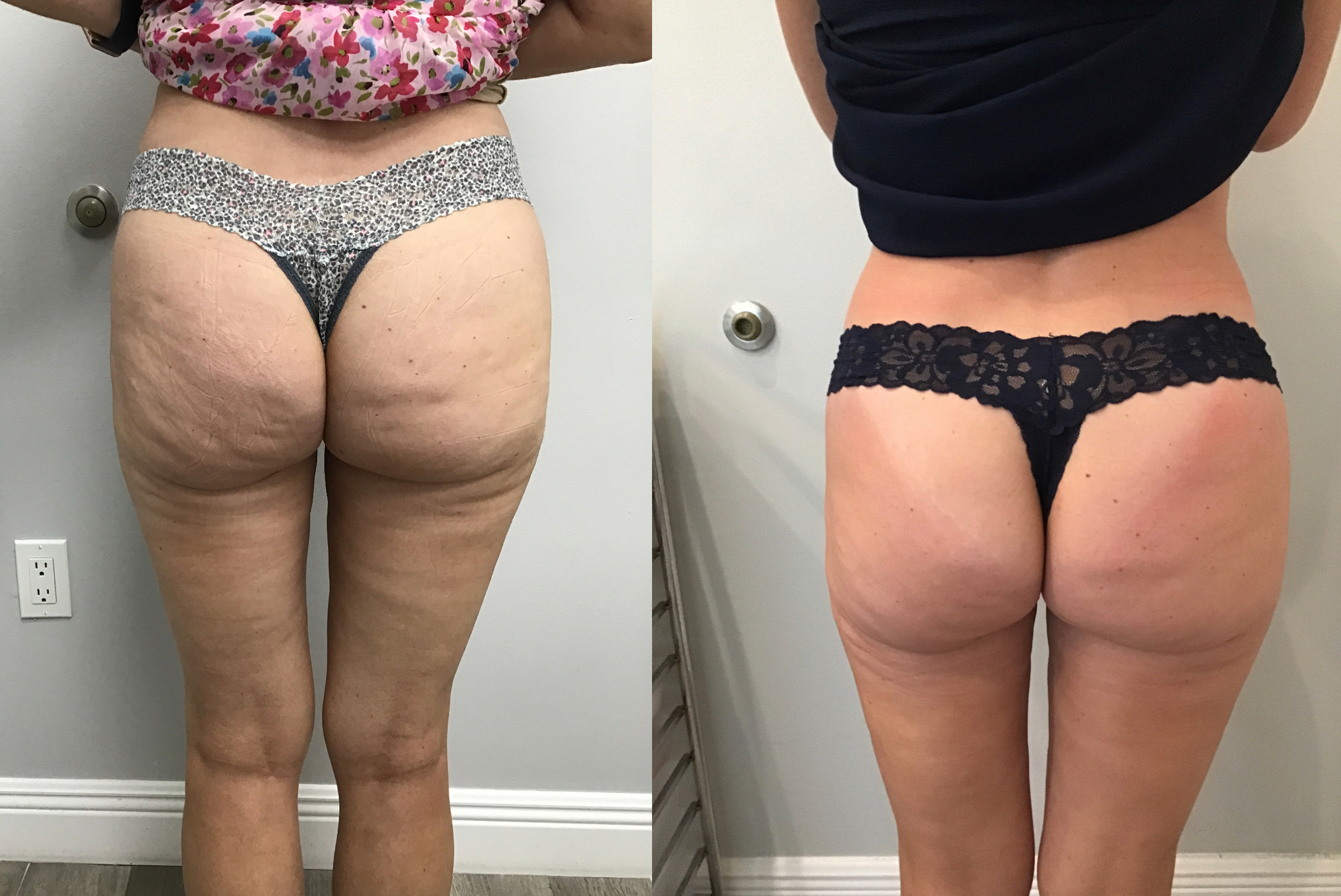 Before and After photo of EmSculpt Neo® glute treatments