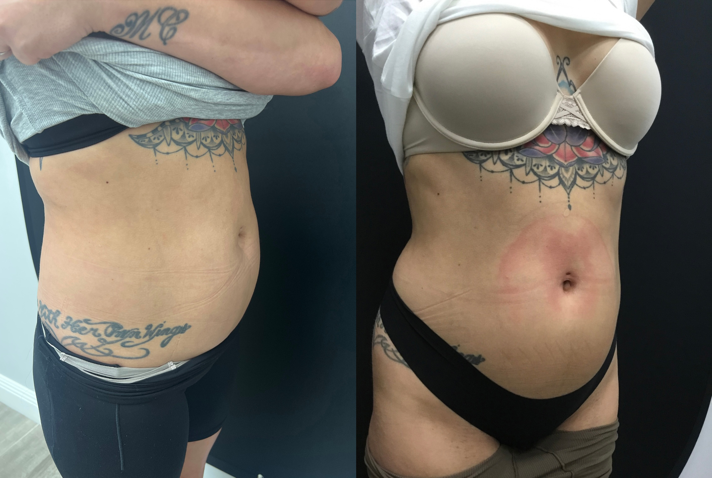 Before and After photo of EmSculpt Neo® Ab treatments