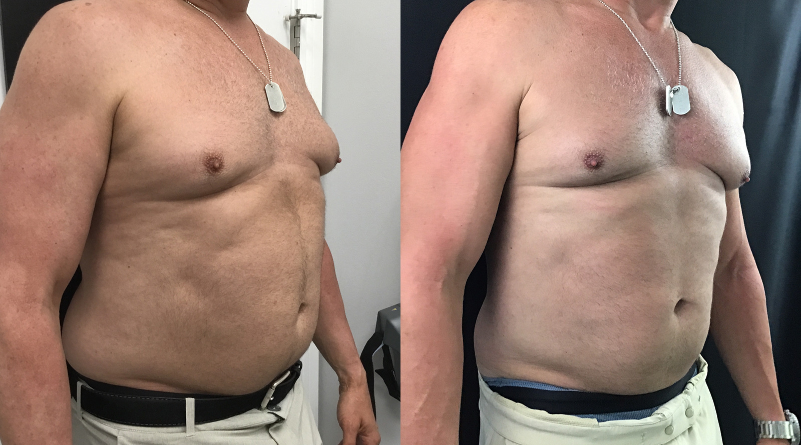 EmSculpt NEO® Before and After Photo by Aqua Laser Studio in Jupiter, FL