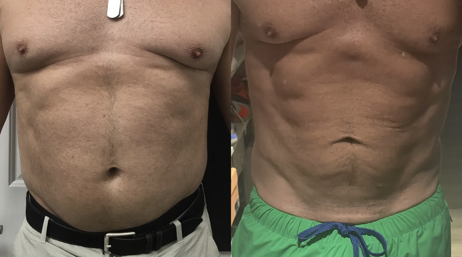 EmSculpt NEO® Before and After Photo by Aqua Laser Studio in Jupiter, FL